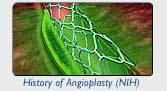 History of Angioplasty